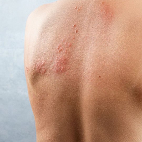 Postherpetik Nevralji Nedir, Belirtileri ve Tedavisi