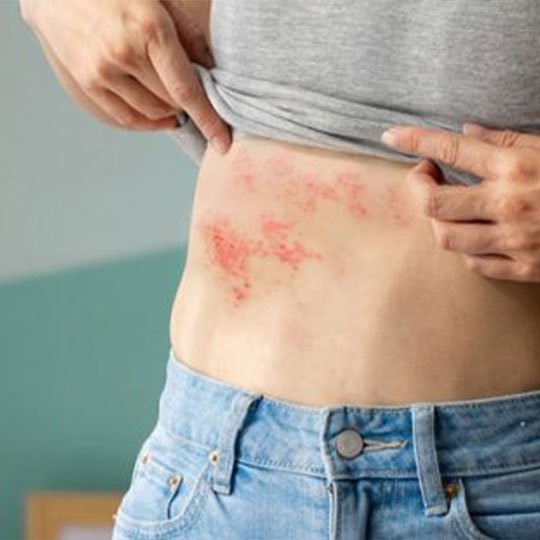 Postherpetik Nevralji