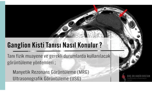 ganglion kisti tanisi nasil konur