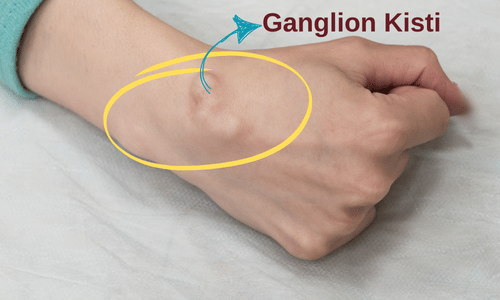 ganglion kisti